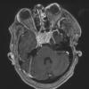 4A4 Granulomatous Hypophysitis (Case 4) T1W