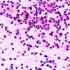 4B1 Granulomatous Hypophysitis (Case 4) Smear H&E 40X 2