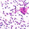 4B2 Granulomatous Hypophysitis (Case 4) Smear H&E 40X