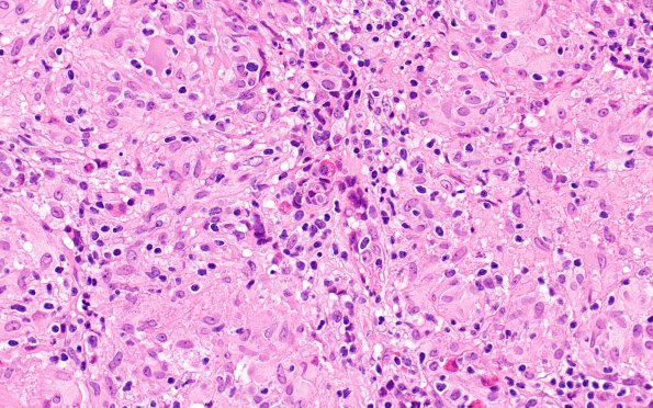 4C5 Granulomatous Hypophysitis (Case 4) A3 H&E 40X 6