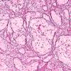 4D2 Granulomatous Hypophysitis (Case 4) A3 Retic 20X 1