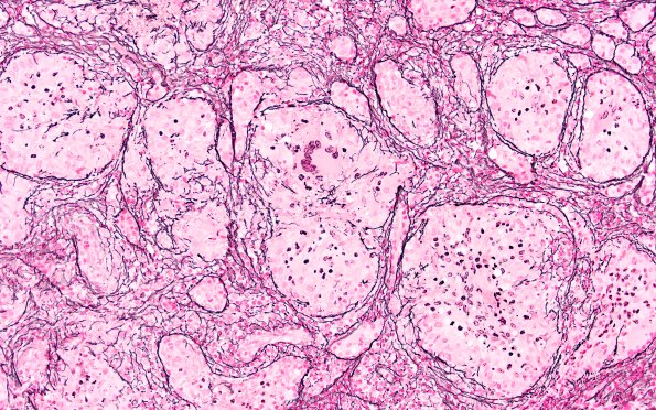 4D2 Granulomatous Hypophysitis (Case 4) A3 Retic 20X 1