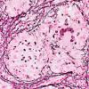 4D4 Granulomatous Hypophysitis (Case 4) A3 Retic 40X 2