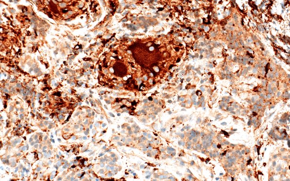 4E5 Granulomatous Hypophysitis (Case 4) A3 CD68 40X 2