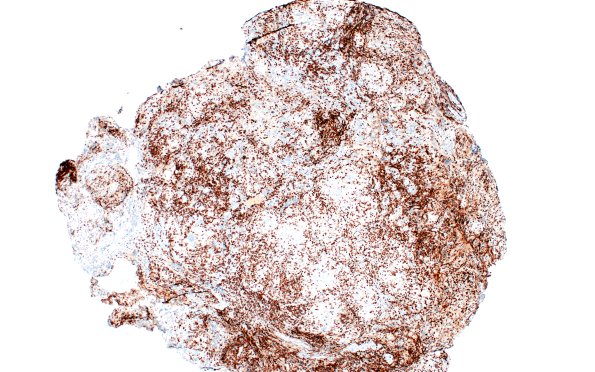 4F1 Granulomatous Hypophysitis (Case 4) A3 CD3 4X 2