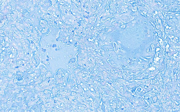 4H1 Granulomatous Hypophysitis (Case 4) A3 AFB 40X 2