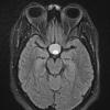 1A1 Lymphocytic Hypophysitis (Case 1) FLAIR - Copy