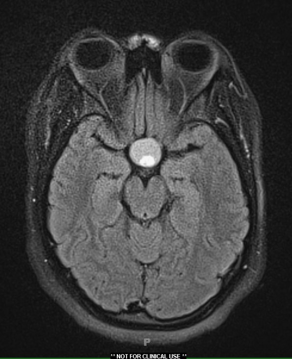 1A1 Lymphocytic Hypophysitis (Case 1) FLAIR - Copy