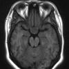 1A2 Lymphocytic Hypophysitis (Case 1) T1 no contrast 2 - Copy