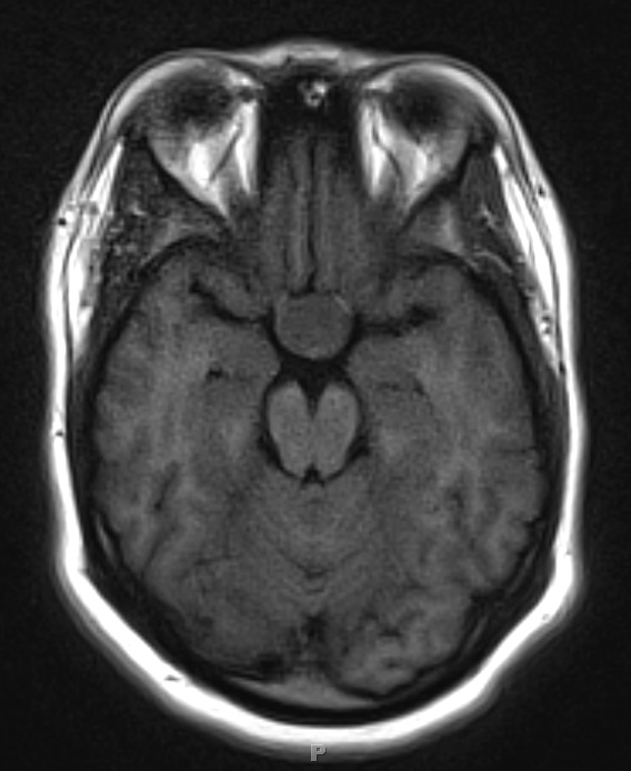 1A2 Lymphocytic Hypophysitis (Case 1) T1 no contrast 2 - Copy