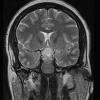 1A3 Lymphocytic Hypophysitis (Case 1) T2 HIRES no contrast 2 - Copy