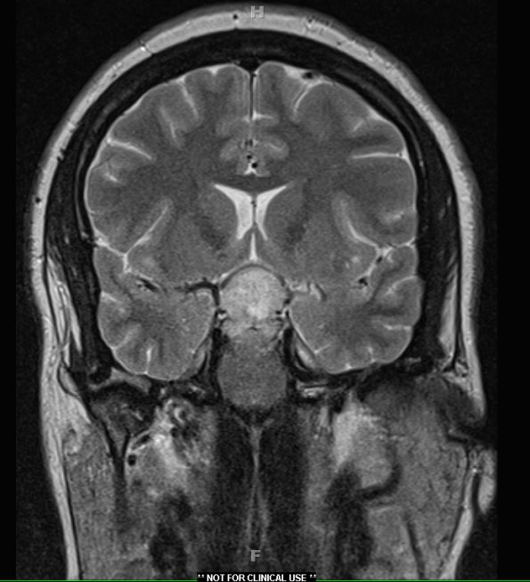 1A3 Lymphocytic Hypophysitis (Case 1) T2 HIRES no contrast 2 - Copy