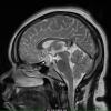 1A4 Lymphocytic Hypophysitis (Case 1) T2 no contrast 2 - Copy copy