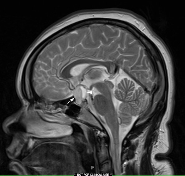 1A4 Lymphocytic Hypophysitis (Case 1) T2 no contrast 2 - Copy copy