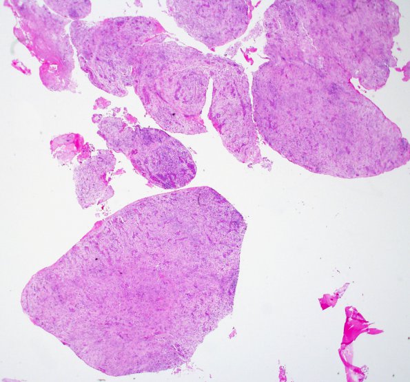 1B1 Lymphocytic Hypophysitis (Case 1) H&E 2X