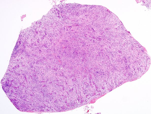 1B2 Lymphocytic Hypophysitis (Case 1) H&E 1