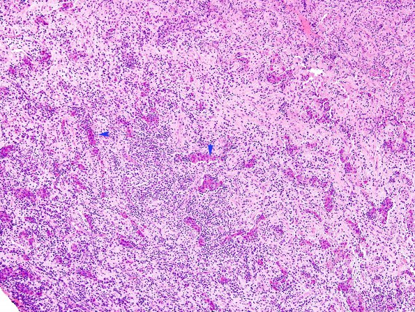 1B3 Lymphocytic Hypophysitis (Case 1) H&E 2 copy