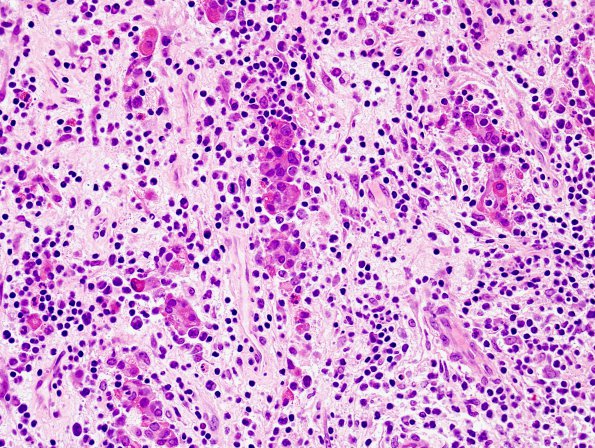 1B4 Lymphocytic Hypophysitis (Case 1) H&E 5