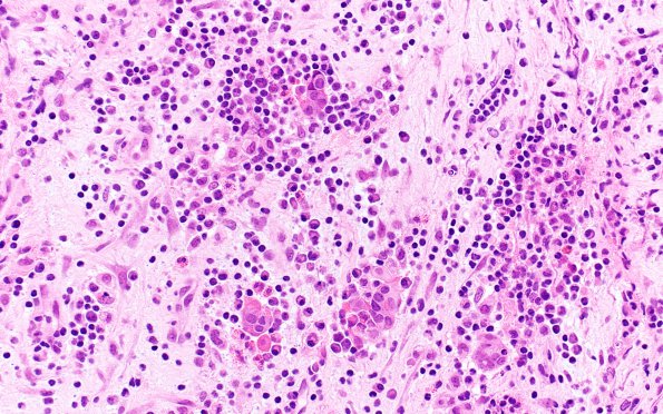 1B5 Lymphocytic Hypophysitis (Case 1) H&E 1 (2)