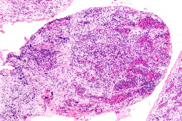 1B6 Lymphocytic Hypophysitis (Case 1) H&E 14A