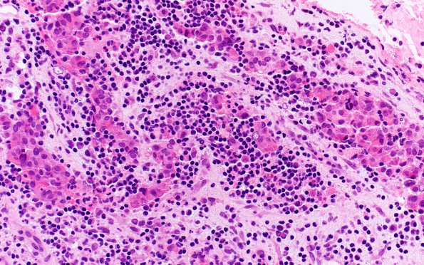 1B7 Lymphocytic Hypophysitis (Case 1) H&E 3 (2)