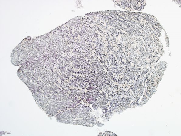 1C1 Lymphocytic Hypophysitis (Case 1) Retic 1