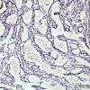 1C2 Lymphocytic Hypophysitis (Case 1) Retic 8