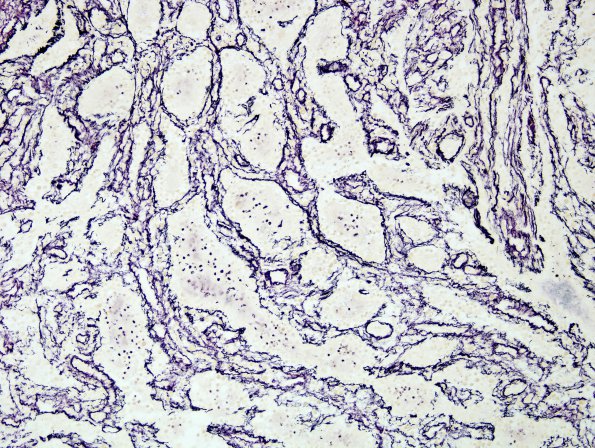 1C2 Lymphocytic Hypophysitis (Case 1) Retic 8