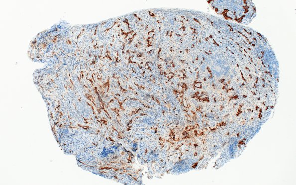 1D1 Lymphocytic Hypophysitis (Case 1) Synaptophysin 4X