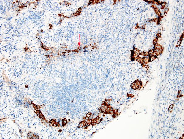 1D2 Lymphocytic Hypophysitis (Case 1) SYN 7 copy