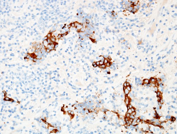 1D3 Lymphocytic Hypophysitis (Case 1) SYN 8