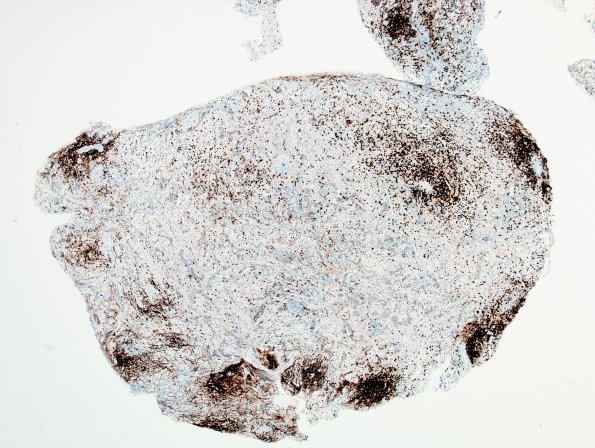 1F2 Lymphocytic Hypophysitis (Case 1) CD20 2