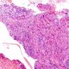 2A1 Lymphocytic hypophysitis (Case 2) H&E 5