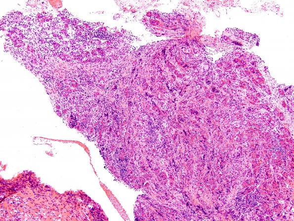 2A1 Lymphocytic hypophysitis (Case 2) H&E 5