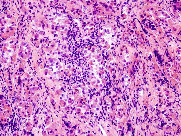 2A3 Lymphocytic hypophysitis (Case 2) H&E 1