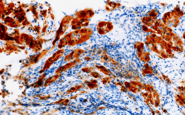 2B2 Lymphocytic Hypophysitis (Case 2) Synaptophysin 3