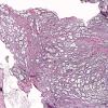 2C1 Lymphocytic hypophysitis (Case 2) Retic 1