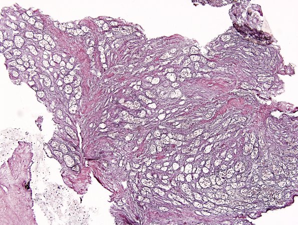 2C1 Lymphocytic hypophysitis (Case 2) Retic 1