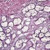 2C2 Lymphocytic hypophysitis (Case 2) Retic 2