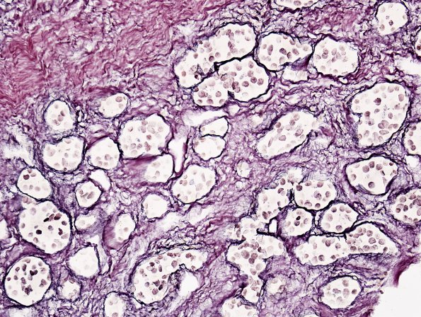 2C2 Lymphocytic hypophysitis (Case 2) Retic 2