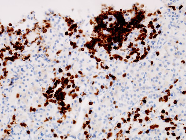 2D1 Lymphocytic hypophysitis (Case 2) CD3 1