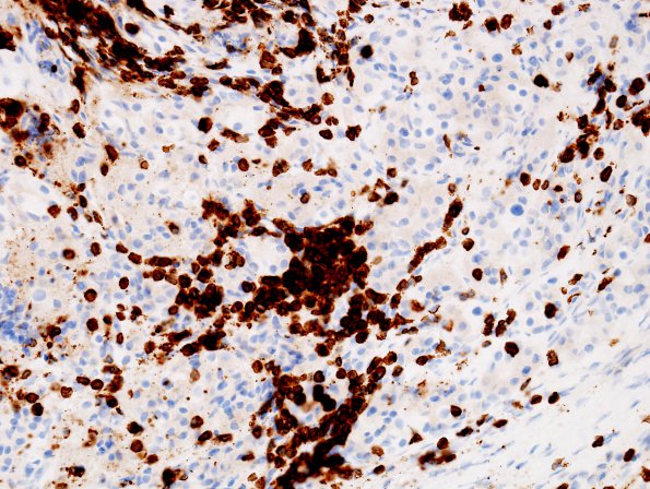 2D2 Lymphocytic hypophysitis (Case 2) CD3 2