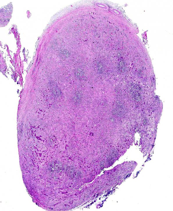 3A1 Lymphoid hypophysitis (AANP 1975, Case 6) H&E X1.1