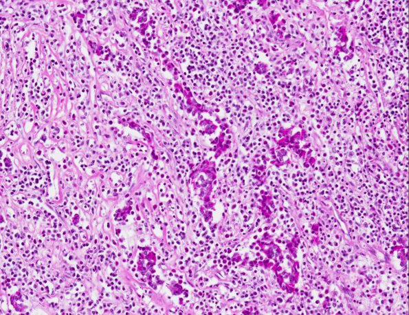 3A3 Lymphoid hypophysitis (AANP 1975, Case 6) H&E X20 1