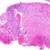 4A1 Lymphocytic Hypophysitis (Case 4) H&E A1 copy