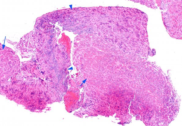 4A1 Lymphocytic Hypophysitis (Case 4) H&E A1 copy