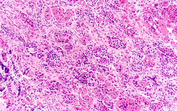 4A2 Lymphocytic Hypophysitis (Case 4) H&E A3