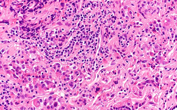 4A3 Lymphocytic Hypophysitis (Case 4) H&E A5