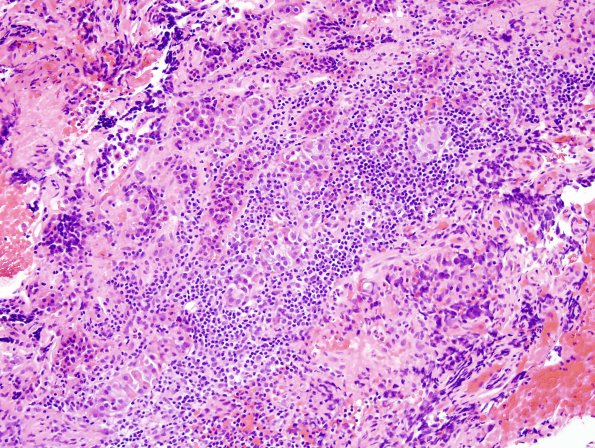 4A5 Lymphocytic hypophysis (Case 4) H&E 2