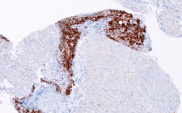 4B1 Lymphocytic Hypophysitis (Case 4) CD3 4X 1